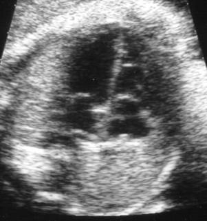 Scan of fetal heart